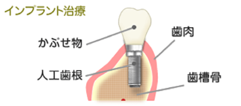 見た目や使用感が良い「インプラント」